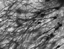 Golgi stained neurons in the dentate gyrus of an epilepsy patient
