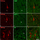 PHF-tau-ir neurons - chandelier cell axon terminals
